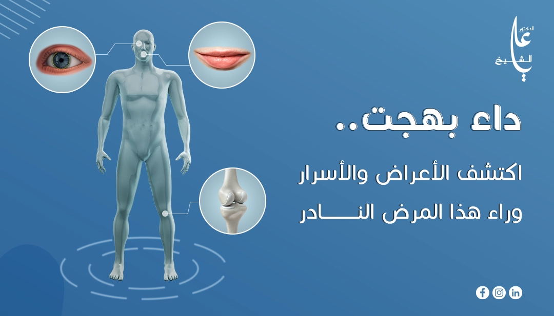 داء بهجت: كل ما تحتاج معرفته عن الأعراض، الأسباب والعلاج